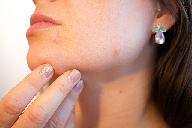 Woman touching acne on her face